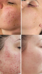 Niacinamida 20% Kit Adios Manchas